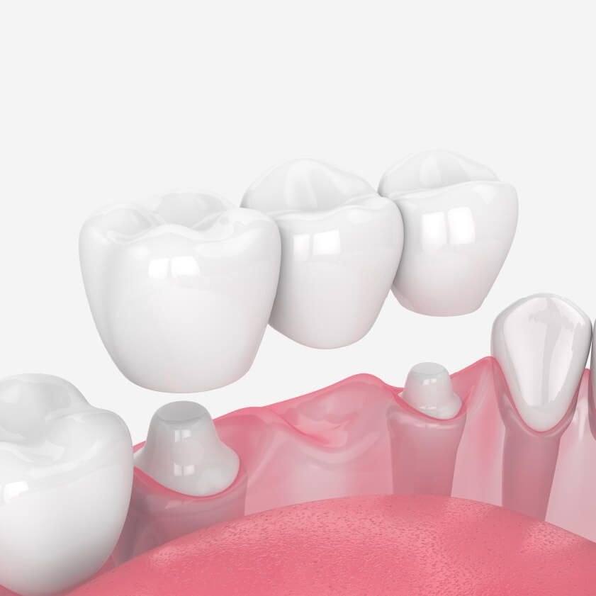 Dental Bridge images | Kokua Smile