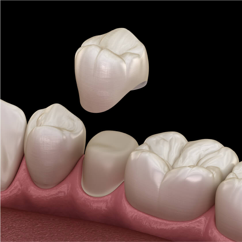 Image of Dental Crown | Kokua Smile