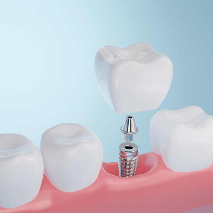 Dental Implants Image | Kokua Smile