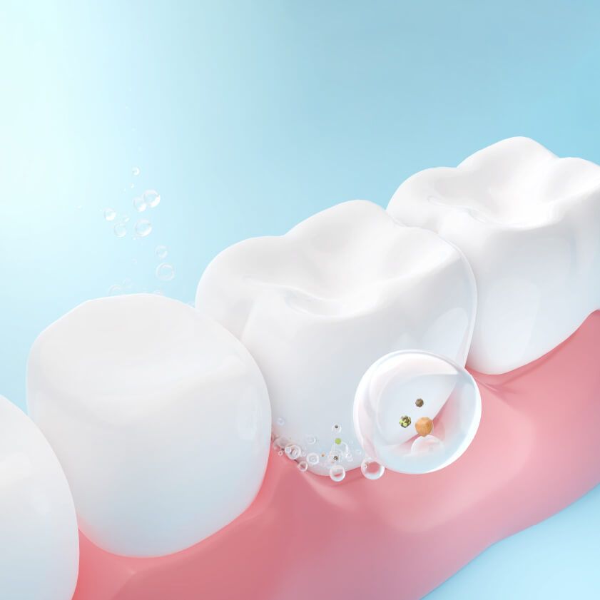 Fluoride treatment of teeth | Kokua Smiles